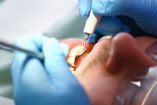 Best Knocked-Out Tooth (Avulsed Tooth) Treatment in Villa Ridge, MO